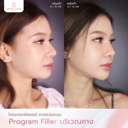 รีวิว Filler