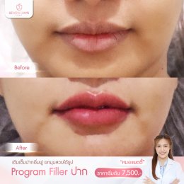 รีวิว Filler