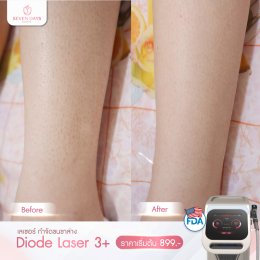 รีวิว Diode Laser กำจัดขน