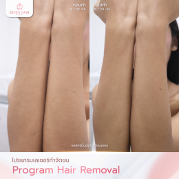 รีวิว Diode Laser กำจัดขน