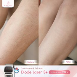 รีวิว Diode Laser กำจัดขน