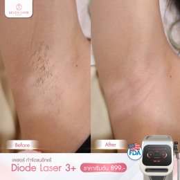 รีวิว Diode Laser กำจัดขน