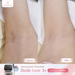 รีวิว Diode Laser กำจัดขน