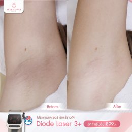 รีวิว Diode Laser กำจัดขน