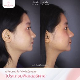 รีวิว Filler