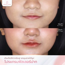รีวิว Filler