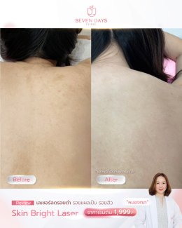 สิวหลัง ( Back Acne )