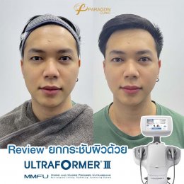 Ultraformer III แก้หย่อนคล้อย ริ้วรอยหาย คลี่คลายทุกกังวล