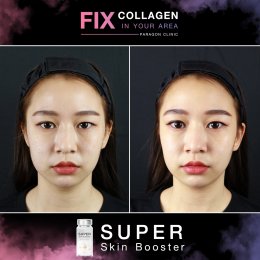 Fix Collagen In Your Area Skin Quality