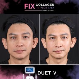 Fix Collagen In Your Area Skin Lifting