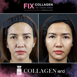 Fix Collagen In Your Area Skin Quality