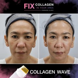 Fix Collagen In Your Area Skin Quality