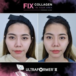 Fix Collagen In Your Area Skin Lifting