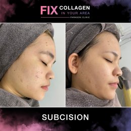 Fix Collagen In Your Area Skin Quality