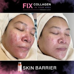 Fix Collagen In Your Area Skin Quality