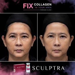 Fix Collagen In Your Area Skin Quality