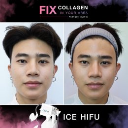 Fix Collagen In Your Area Skin Lifting