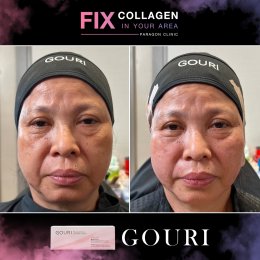 Fix Collagen In Your Area Skin Quality