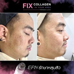 Fix Collagen In Your Area Skin Lifting