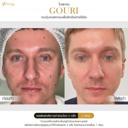 Gouri Collagen PCL 21% สร้างคอลลาเจนอย่างยั่งยืน เปลี่ยนผิวเก่าเป็นผิวใหม่