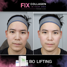 Fix Collagen In Your Area Skin Lifting