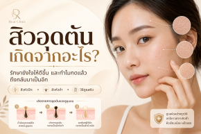 สิวอุดตันเกิดจากอะไร? รักษายังไงให้ดีขึ้น และทำไมกดแล้วถึงกลับมาเป็นอีก