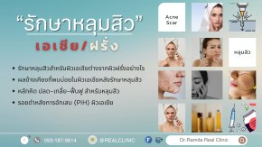 รักษาหลุมสิวฉบับผิวเอเชีย: ทำไมต้องรักษาคนละวิธีกับฝรั่ง? 