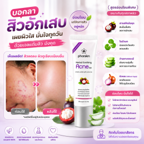 สารสกัดเปลือกมังคุดกับสิว ช่วยดูแลผิวเป็นสิวได้อย่างไร?