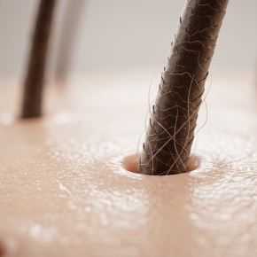 DHT คืออะไร? ทำไมถึงเป็นสาเหตุสำคัญของผมบางและผมร่วง