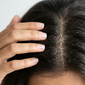 รังแคแบบแห้ง vs รังแคแบบมัน ต่างกันอย่างไร