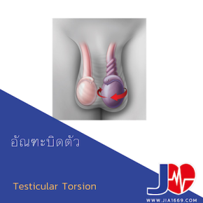 Testicular Torsion อัณฑะบิดตัว