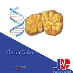 Lipoma เนื้องอกไขมัน