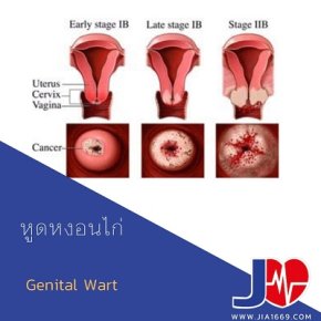 Genital wart หูดหงอนไก่