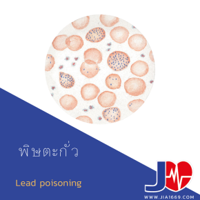 Lead poisoning