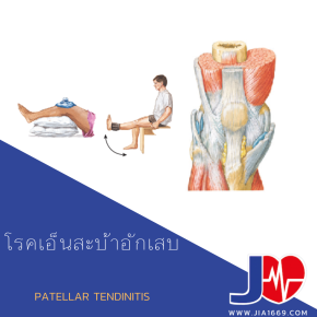 PATELLAR TENDINITIS 