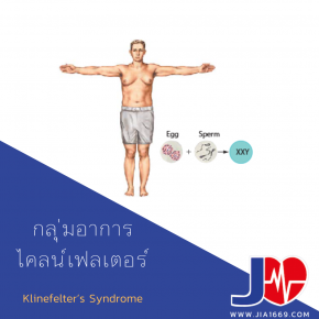 Klinefelter’s Syndrome 