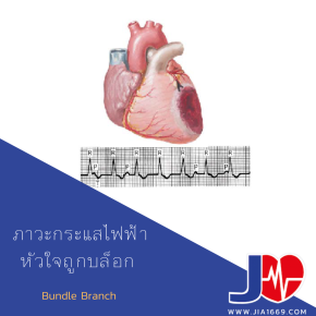  Bundle Branch Block