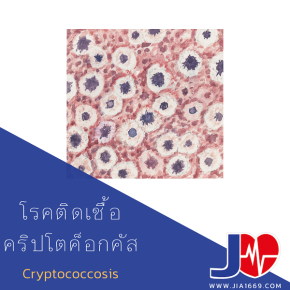 โรคติดเชื้อ คริปโตค็อกคัส