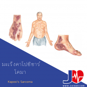 Kaposi’s Sarcoma 