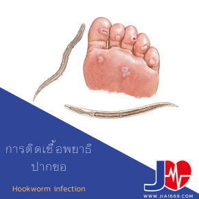 การติดเชื้อพยาธิปากขอ