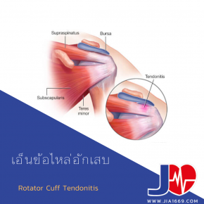 Rotator Cuff Tendonitis