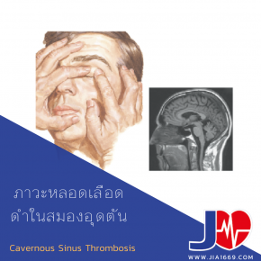 Cavernous Sinus Thrombosis 