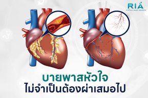 บายพาสหัวใจ ไม่จำเป็นต้องผ่าเสมอไป