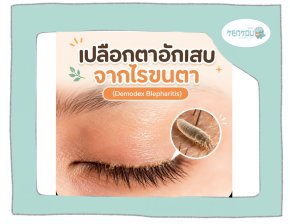 เปลือกตาอักเสบจากไรขนตา (Demodex Blepharitis) คืออะไร? ประคบอุ่นช่วยได้จริงไหม