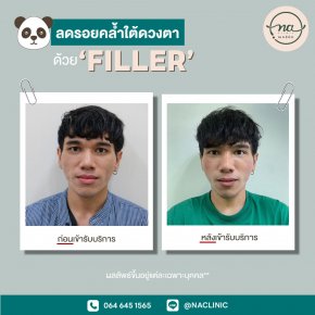 Filler ใต้ตา 2cc by หมอวิค