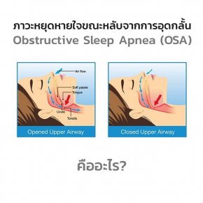 ภาวะหยุดหายใจขณะหลับจากการอุดกลั้น Obstructive Sleep Apnea (OSA) คืออะไร ?