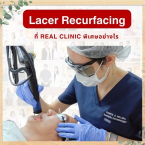 การทำ Laser resurfacing เลเซอร์เกลี่ยขอบหลุมสิว (เลเซอร์หลุมสิว) ที่ Real Clinic