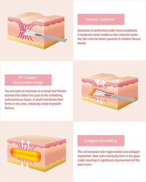 subcision หลุมสิว คืออะไร? ทำแล้วดีอย่างไร 