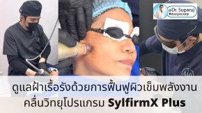 รักษาฝ้า ด้วยการฟื้นฟูผิวด้วยการใช้ เข็มพลังงานคลื่นวิทยุโปรแกรม SylfirmX Plus + โปรแกรม Exosomes (Program SylfirmX Plus Fractional RF MicroNeedle + Program Exosomes for Melasma Skin Rehabilitation)