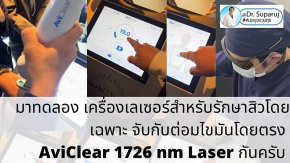 Update เครื่องเลเซอร์สำหรับรักษาสิวโดยเฉพาะ จับกับต่อมไขมันโดยตรง = AviClear 1726 nm Laser